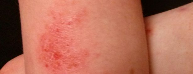 Eczema